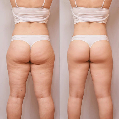 Celluless MD: Sistema de Vacumterapia Anticelulitis