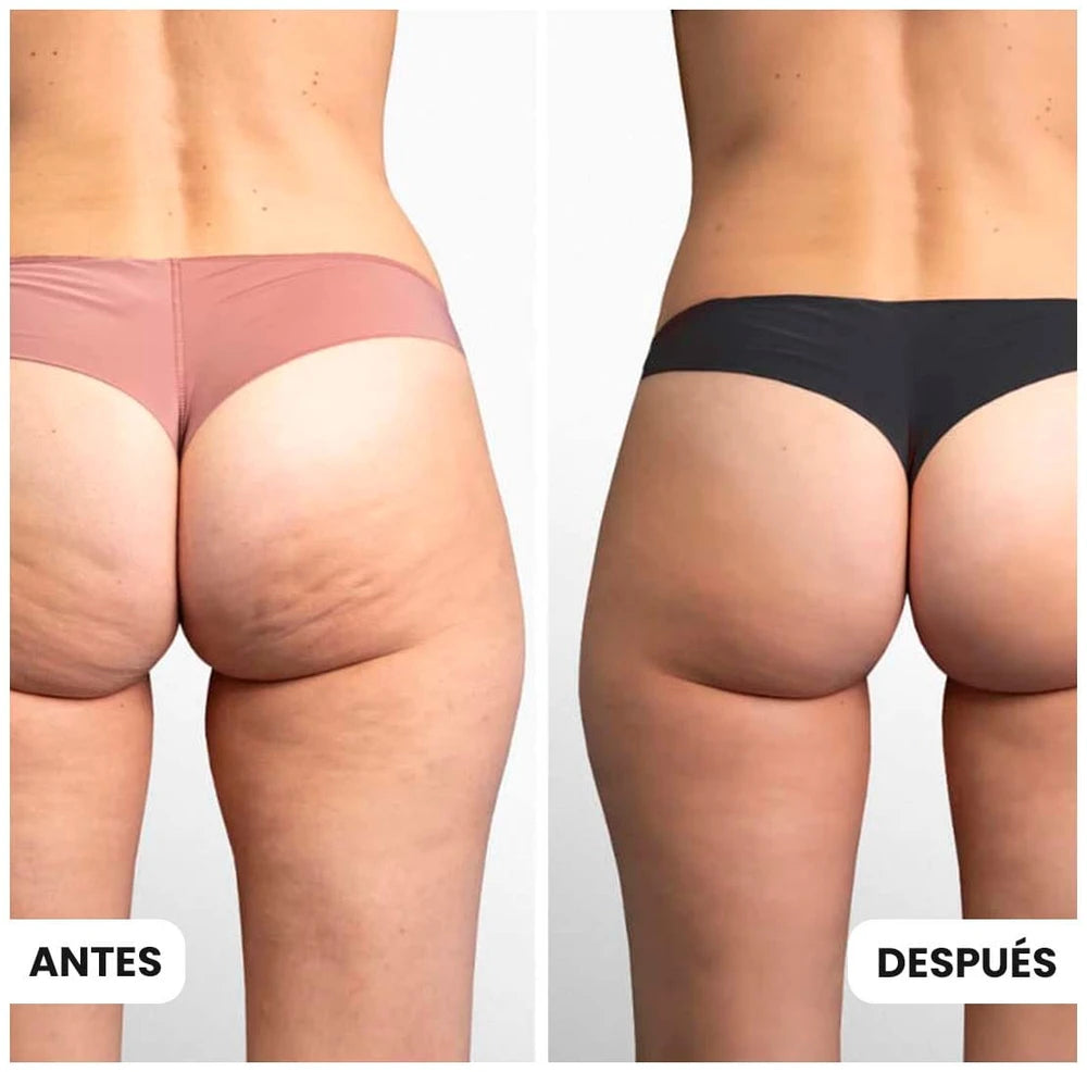 Celluless MD: Sistema de Vacumterapia Anticelulitis